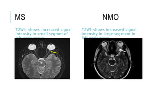MS NMO
T2WI- shows increased signal
intensity in small segmnt of
left optic nerve
T2WI-shows increased signal
intensity in large segment in
left optic nerve
 