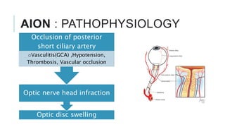 AION : PATHOPHYSIOLOGY
Optic disc swelling
Optic nerve head infraction
Occlusion of posterior
short ciliary artery
oVasculitis(GCA) ,Hypotension,
Thrombosis, Vascular occlusion
 