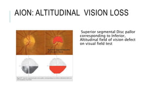 AION: ALTITUDINAL VISION LOSS
Superior segmental Disc pallor
corresponding to Inferior,
Altitudinal field of vision defect
on visual field test
 