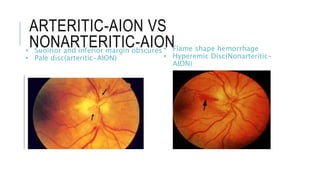 ARTERITIC-AION VS
NONARTERITIC-AION
• Suoirior and inferior margin obscures
• Pale disc(arteritic-AION)
• Flame shape hemorrhage
• Hyperemic Disc(Nonarteritic-
AION)
 