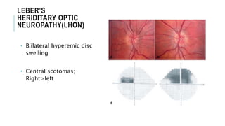 LEBER’S
HERIDITARY OPTIC
NEUROPATHY(LHON)
• Blilateral hyperemic disc
swelling
• Central scotomas;
Right>left
 