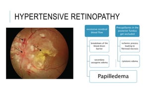 HYPERTENSIVE RETINOPATHY
excessive cerebral
blood flow
breakdown of the
blood–brain
barrier
secondary
vasogenic edema
Papilledema
Precapillaries in the
posterior fundus
get occluded
ischemic process
leading to
fibrinoid necrosis
cytotoxic edema
 