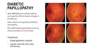 DIABETIC
PAPILLOPATHY
(A and B) Bilateral marked swelling
and superficial flame haemorrhages in
the left eye.
Note, absence of significant diabetic
retinopathy.
(C and D) Swelling gradually resolving
without atrophy 3 months later.
Treatment:
• Good glycemic control
• regular intervals with close
monitoring.
 