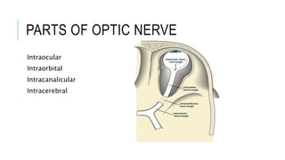 PARTS OF OPTIC NERVE
Intraocular
Intraorbital
Intracanalicular
Intracerebral
 