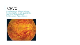CRVO
Papilledema ;Flame shape
hemorrgahe in all qudrants
Macular hemorrhage
Setting sun Appearance
 