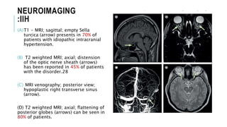 NEUROIMAGING
:IIH
(A)T1 - MRI; sagittal; empty Sella
turcica (arrow) presents in 70% of
patients with idiopathic intracranial
hypertension.
(B) T2 weighted MRI; axial; distension
of the optic nerve sheath (arrows)
has been reported in 45% of patients
with the disorder.28
(C) MRI venography; posterior view;
hypoplastic right transverse sinus
(arrow).
(D) T2 weighted MRI; axial; flattening of
posterior globes (arrows) can be seen in
80% of patients.
 