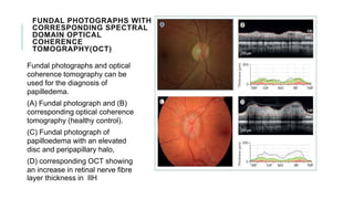 FUNDAL PHOTOGRAPHS WITH
CORRESPONDING SPECTRAL
DOMAIN OPTICAL
COHERENCE
TOMOGRAPHY(OCT)
Fundal photographs and optical
coherence tomography can be
used for the diagnosis of
papilledema.
(A) Fundal photograph and (B)
corresponding optical coherence
tomography (healthy control).
(C) Fundal photograph of
papilloedema with an elevated
disc and peripapillary halo,
(D) corresponding OCT showing
an increase in retinal nerve fibre
layer thickness in IIH
 