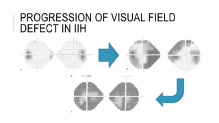 PROGRESSION OF VISUAL FIELD
DEFECT IN IIH
 