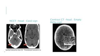 NCCT -head : Cord sign
Contrast CT –head : Empty
Delta sign
 