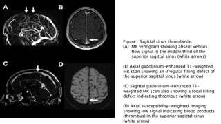 Figure : Sagittal sinus thrombosis.
(A) MR venogram showing absent venous
flow signal in the middle third of the
superior sagittal sinus (white arrows)
(B) Axial gadolinium-enhanced T1-weighted
MR scan showing an irregular filling defect of
the superior sagittal sinus (white arrow)
(C) Sagittal gadolinium-enhanced T1-
weighted MR scan also showing a focal filling
defect indicating thrombus (white arrow)
(D) Axial susceptibility-weighted imaging
showing low signal indicating blood products
(thrombus) in the superior sagittal sinus
(white arrow)
 