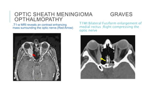 OPTIC SHEATH MENINGIOMA GRAVES
OPTHALMOPATHY
,T1-w MRI reveals an contrast enhancing
mass surrounding the optic nerve.(Red Arrow)
T1WI:Bilateral Fusiform enlargement of
medial rectus ;Right compressing the
optic nerve
 