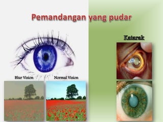 Pemandangan yang pudarKatarakBlur VisionNormal Vision