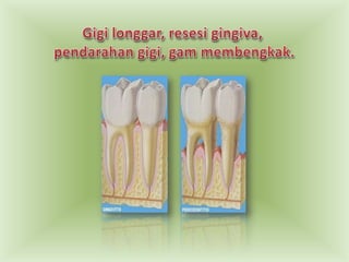 Gigilonggar, resesigingiva, pendarahangigi, gammembengkak.