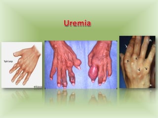  Uremia