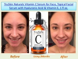 TruSkin Naturals Vitamin C Serum for Face, Topical Facial
Serum with Hyaluronic Acid & Vitamin E, 1 fl oz.
AfterUsing 2Months
 