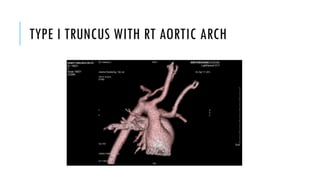 TYPE I TRUNCUS WITH RT AORTIC ARCH
 