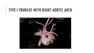 TYPE I TRUNCUS WITH RIGHT AORTIC ARCH
 