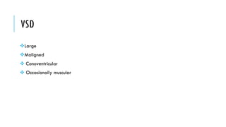 VSD
Large
Maligned
 Conoventricular
 Occasionally muscular
 