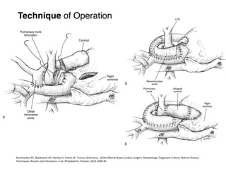 Truncus Methods Truncus Arteriosus: Assessment and Surgical Management | PDF