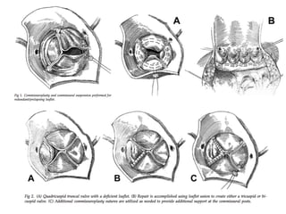 Truncus Arteriosus: Assessment and Surgical Management | PDF