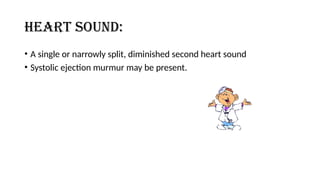 HEART SOUND:
• A single or narrowly split, diminished second heart sound
• Systolic ejection murmur may be present.
 