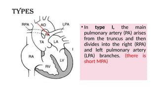 Types
• In type I, the main
pulmonary artery (PA) arises
from the truncus and then
divides into the right (RPA)
and left pulmonary artery
(LPA) branches. (there is
short MPA)
 