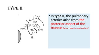 Type II
•In type II, the pulmonary
arteries arise from the
posterior aspect of the
truncus (very close to each other )
 