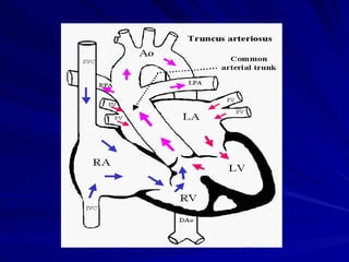 TRUNCUS ARTERIOSUS,TRUNCUS ARTERIOSUS,.ppt.ppt
