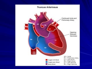 Truncus Methods TRUNCUS ARTERIOSUS,TRUNCUS ARTERIOSUS,.ppt.ppt