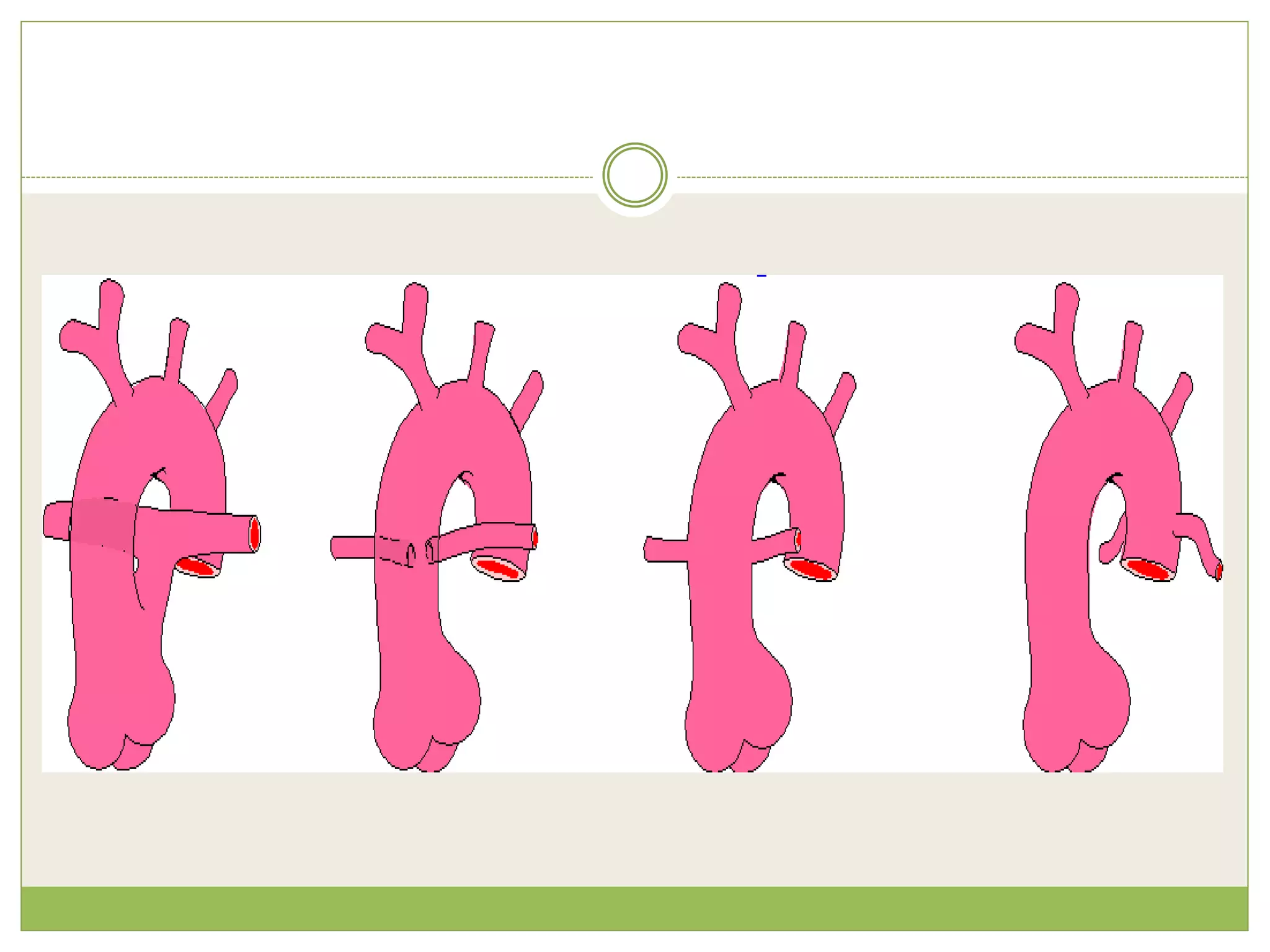 Truncus Methods Truncus Arteriosus | PPTX