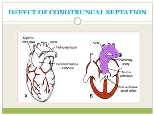 DEFECT OF CONOTRUNCAL SEPTATION
 