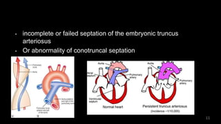• incomplete or failed septation of the embryonic truncus
arteriosus
• Or abnormality of conotruncal septation
11
 