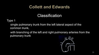 Classification
Type 1
single pulmonary trunk from the left lateral aspect of the
common trunk,
with branching of the left and right pulmonary arteries from the
pulmonary trunk
28
 
