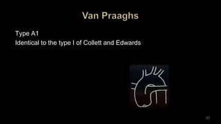 Type A1
Identical to the type I of Collett and Edwards
37
 