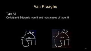 Type A2
Collett and Edwards type II and most cases of type III
39
 