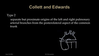 Type 2
separate but proximate origins of the left and right pulmonary
arterial branches from the posterolateral aspect of the common
trunk
June 10, 2014 Dr S.Sivasankar
 