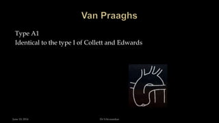 Type A1
Identical to the type I of Collett and Edwards
June 10, 2014 Dr S.Sivasankar
 