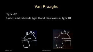 Type A2
Collett and Edwards type II and most cases of type III
June 10, 2014 Dr S.Sivasankar
 