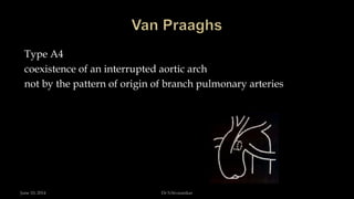 Type A4
coexistence of an interrupted aortic arch
not by the pattern of origin of branch pulmonary arteries
June 10, 2014 Dr S.Sivasankar
 