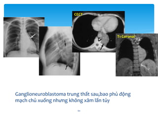 Ganglioneuroblastoma trung thất sau,bao phủ động
mạch chủ xuống nhưng không xâm lấn tủy
60
CECT
T1 Coronal
 