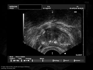 Trus Urology Example TRUS in Evaluation of Male Infertility | PPT