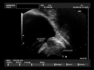 TRUS in Evaluation of Male Infertility | PPT