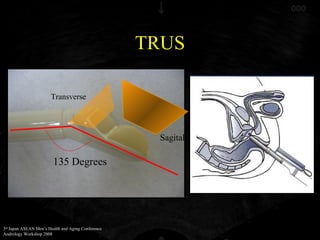 TRUS in Evaluation of Male Infertility | PPT