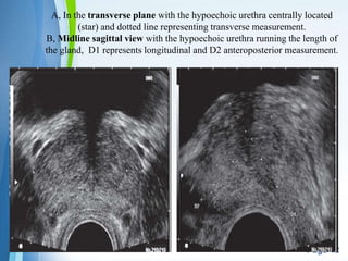 Powerpoint Templates
Page 12
A, In the transverse plane with the hypoechoic urethra centrally located
(star) and dotted line representing transverse measurement.
B, Midline sagittal view with the hypoechoic urethra running the length of
the gland, D1 represents longitudinal and D2 anteroposterior measurement.
 