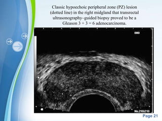 Powerpoint Templates
Page 21
Classic hypoechoic peripheral zone (PZ) lesion
(dotted line) in the right midgland that transrectal
ultrasonography–guided biopsy proved to be a
Gleason 3 + 3 = 6 adenocarcinoma.
 
