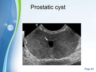 Powerpoint Templates
Page 24
Prostatic cyst
 