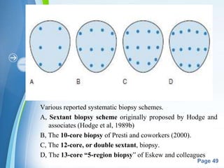 Powerpoint Templates
Page 49
Various reported systematic biopsy schemes.
A, Sextant biopsy scheme originally proposed by Hodge and
associates (Hodge et al, 1989b)
B, The 10-core biopsy of Presti and coworkers (2000).
C, The 12-core, or double sextant, biopsy.
D, The 13-core “5-region biopsy” of Eskew and colleagues
 