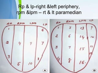 Powerpoint Templates
Page 50
Rp & lp-right &left periphery,
rpm &lpm – rt & lt paramedian
 