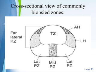 Powerpoint Templates
Page 51
Cross-sectional view of commonly
biopsied zones.
 