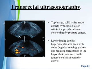 Powerpoint Templates
Page 61
Transrectal ultrasonography.
• Top image, solid white arrow
depicts hypoechoic lesion
within the peripheral zone
concerning for prostate cancer.
• Lower image depicts
hypervascular area seen with
color Doppler imaging, yellow
and red area corresponds to the
hypoechoic area seen on the
grayscale ultrasonography
above.
 